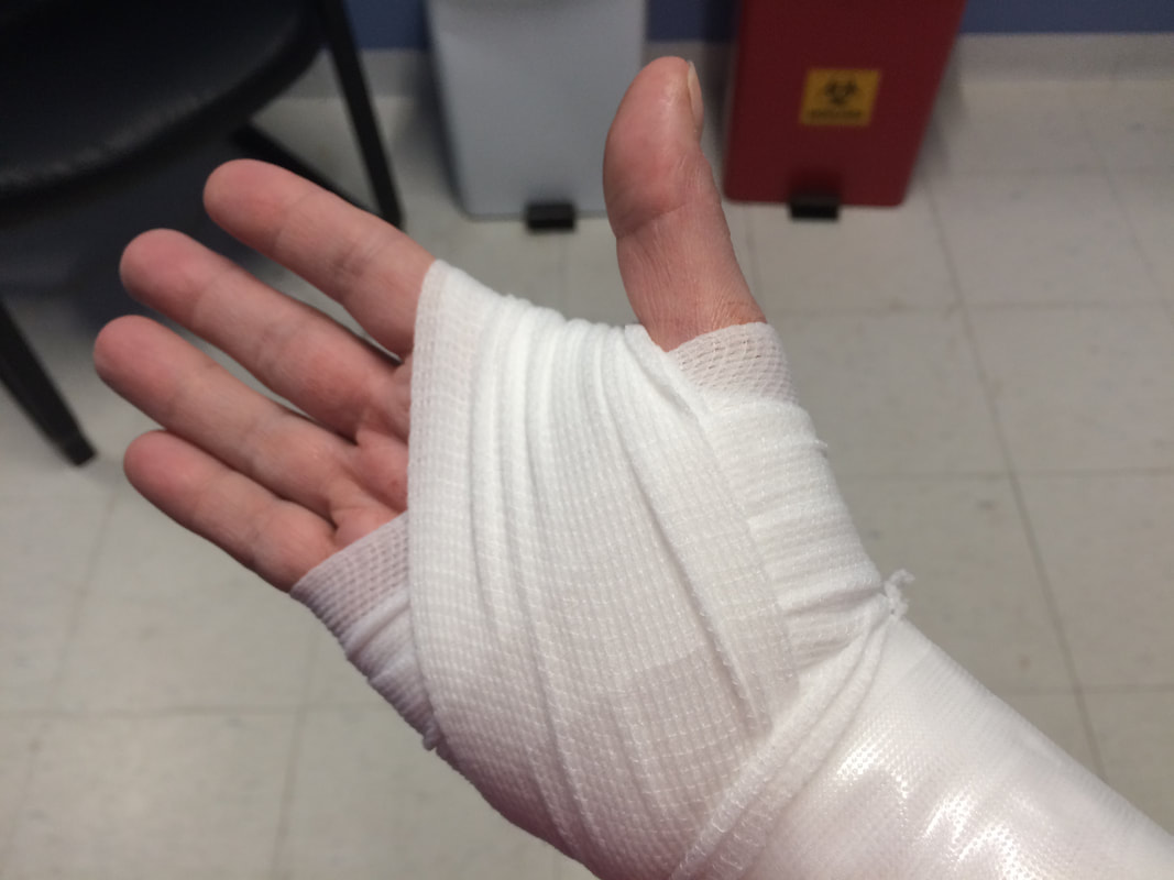Image description: The palm side of a well-bandaged right hand.