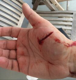 Image description: The palm side of a right hand with a deep gash on the palm near the base of the thumb.